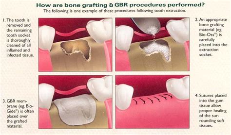 bone grafting Repinned by www.GreenbrierDental.com | Bone grafting ...