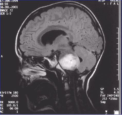 Brain stem gliomas | Neurosurgeon