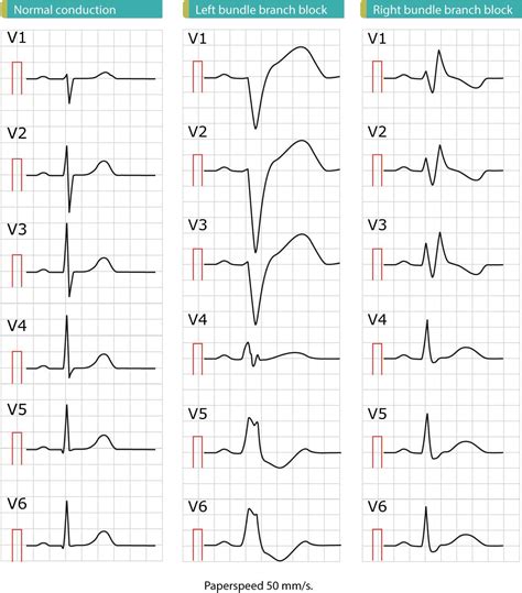 Learn about left bundle branch block (LBBB), with emphasis on ECG ...