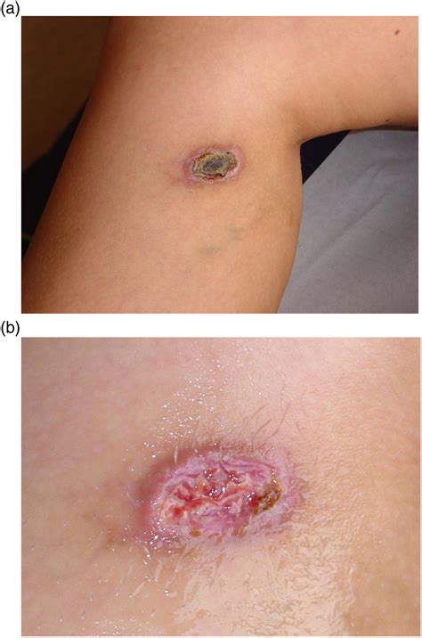 Skin Necrosis Following Part 1: Differential Diagnosis, 49% OFF