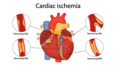 Ischemic Heart Disease and its Management - Apex Hospitals