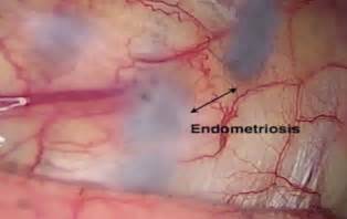 Update in Innovation: Surgical Management of Endometriosis ...