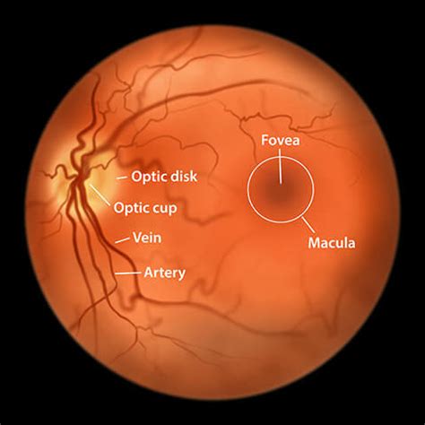 Macular Edema Symptoms Houston | Mann Eye Institute Austin