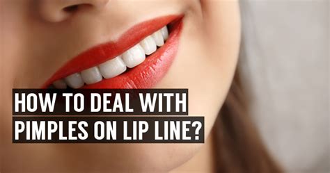 Pimples On Lip : Causes and Learn How to Get Rid of Pimples