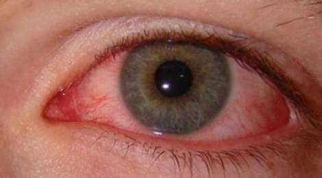 Early Signs of Pink Eye (for Each Type of Conjunctivitis) | EYExan.com