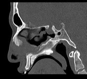 Planum sphenoidale | Radiology Reference Article | Radiopaedia.org