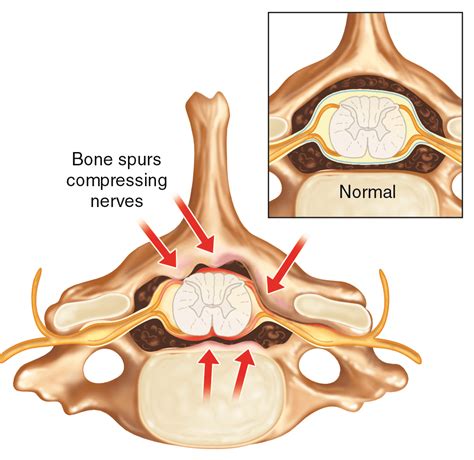 Posterior Cervical Fusion Procedure | Globus Medical