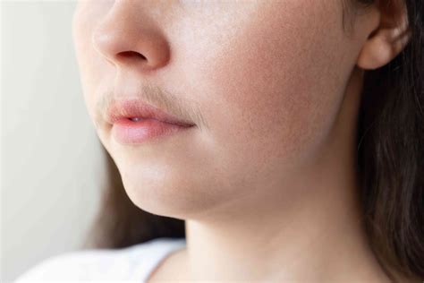 Hirsutism: Symptoms, Causes, Treatment, and More