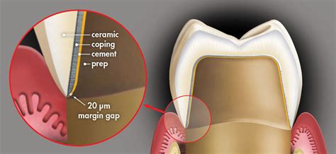 Choosing Between Zirconia Crowns and PFM Crowns | Glidewell