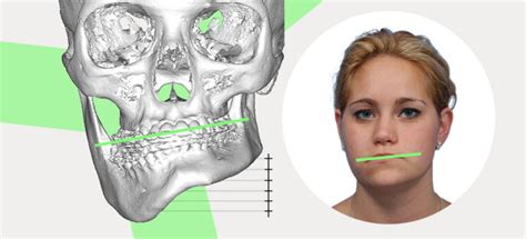 Asymmetrical Jaw & Chin: Causes and How to Fix it Naturally | Mewing.coach