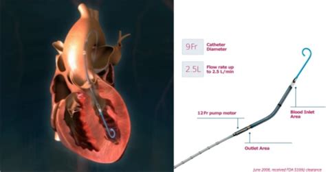 Impella 2.5The Impella pulls blood from the left ventri | Open-i