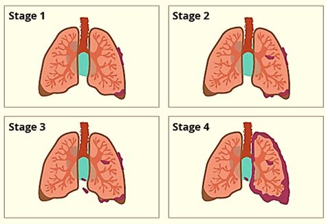 pleural mesothelioma - wikitechy