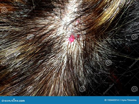 Hemangioma On The Head. Red Mole On The Scalp. Mole In The Hair. Red Birthmark. Stock Photo ...