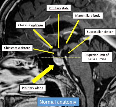 Pituitary Gland Anatomy Mri