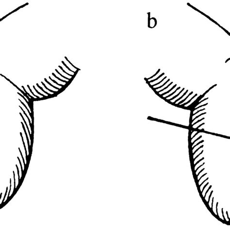 Schamroth test: (a) normal finger, and (b) space between nails is... | Download Scientific Diagram