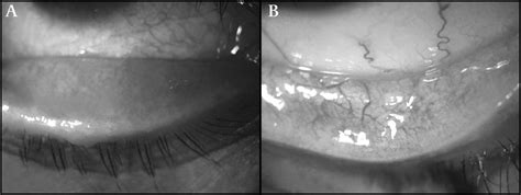 The efficacy of oral ivermectin for the treatment of chronic blepharitis in patients tested ...