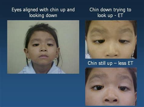 congenital fibrosis syndrome (CFEOM 1) and blepharophimosis syndrome from the "cyber atlas" on ...