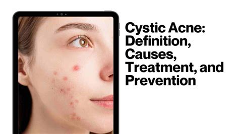 Cystic Acne: Definition, Causes, Treatment, and Prevention