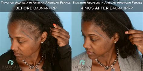 Traction Alopecia Before After PRP Platelet Rich Plasma in African American · Bauman Medical