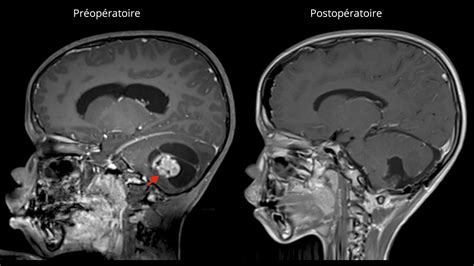 Astrocytome pilocytique | Neurochirurgie Inselspital Bern