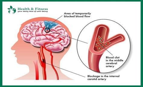 Blood Clot in Brain: Treatment and Symptoms of Blood Clot in Brain