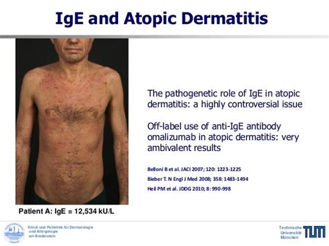 Targeting grossly elevated IgE: a novel therapeutic option in severe