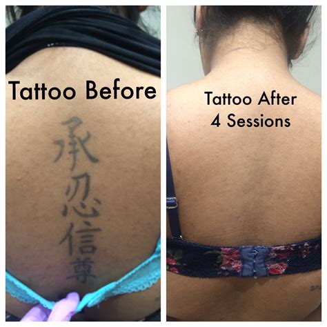 Tattoo Removal Treatment | Laser