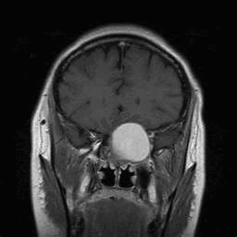 Sphenoid sinus mucocele: 10 cases and literature review | The Journal of Laryngology & Otology ...