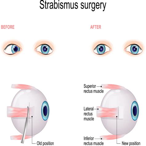 Strabismus Surgery (Procedure, Recovery & Costs)