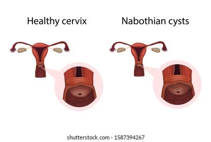 Nabothian Cysts Healthy Organ Cervical Disease Stock Illustration ...