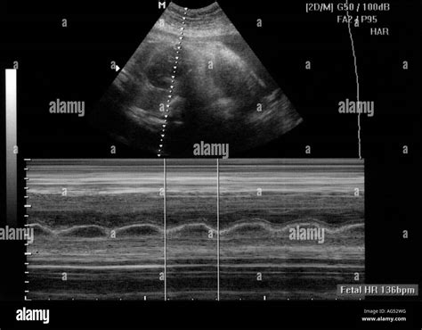 Fetal Cardiac Ultrasound