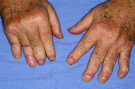 Psoriasis - Appearance, Causes, Types, Symptoms, Treatment, and Diet