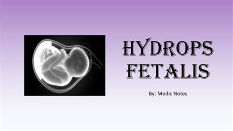 Hydrops fetalis - causes, investigation, management, prognosis - YouTube