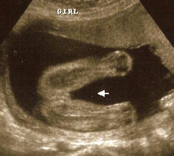 What Does a Baby Girl Look Like on Ultrasound?