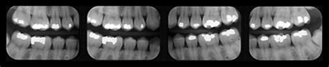 Bitewing Radiographs technique Flashcards | Quizlet