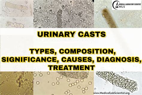 URINARY CASTS: Types, Composition, Significance, Causes, Diagnosis, Treatment - Medical ...