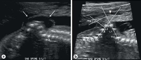 Figure 33 from The Diagnostic Features of Spina Bifida: The Role of Ultrasound | Semantic Scholar