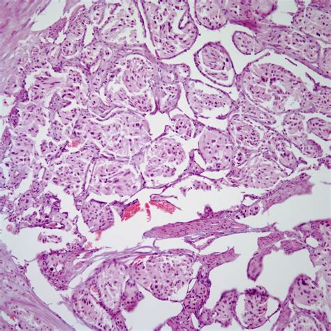 Hematuria in 57-Year-Old Patient