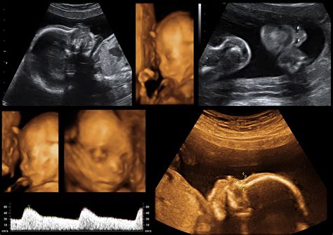 3d Baby Ultrasound Edmonton - Get More Anythink's