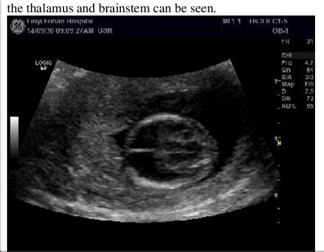 Hydranencephaly Ultrasound