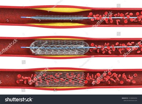 3d Rendering Balloon Angioplasty Procedure Stent Stock Illustration ...