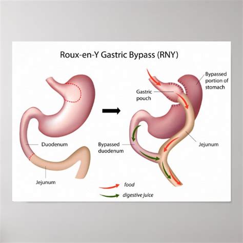 Roux-en-Y Gastric Bypass surgery poster | Zazzle.com