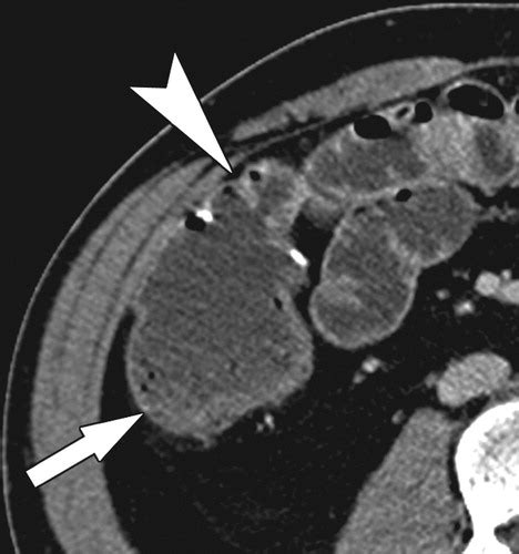 Suspected Anastomotic Recurrence of Crohn Disease after Ileocolic Resection: Evaluation with CT ...