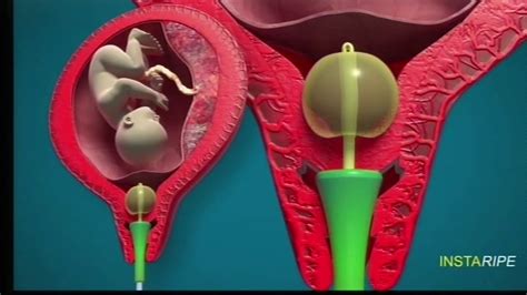 Dr.Panicker's Rapid Cervical Ripening Device (INSTARIPE for Induction of Labour) in French - YouTube