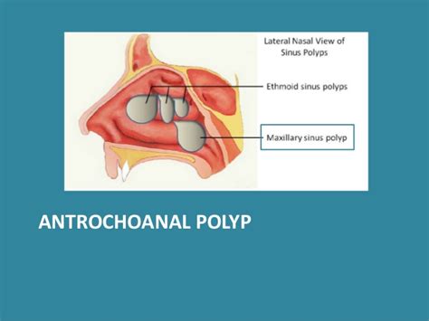 nose - ANTROCHOANAL POLYP - Dr. Meenesh Juvekar - ENT Specialist