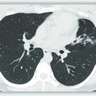 Chest CT (axial reconstruction). Localized cylindrical bronchiectasis... | Download Scientific ...