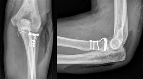 Elbow radial head fracture | doctorvisit