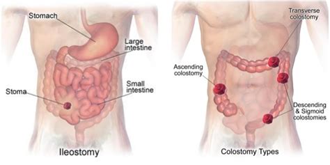 Colostomy - How To Change A Colostomy Bag & Living With It