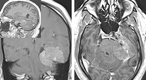 Tentorial Meningioma | The Neurosurgical Atlas