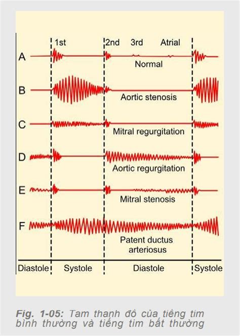 [Bệnh Học Tim Mạch 1] Những Kiến Thức Quan Trọng Nhất Về Tiếng Tim